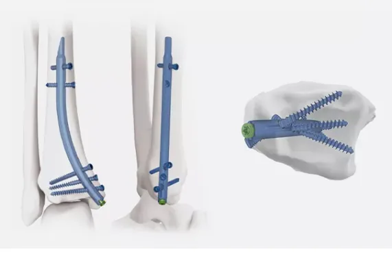Clavo intramedular tibial distal – fijación retrógrada
