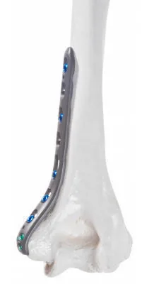 Placa de bloqueo medial para húmero distal