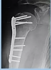 Placa de bloqueo para húmero proximal (LPHP) – imagen 2