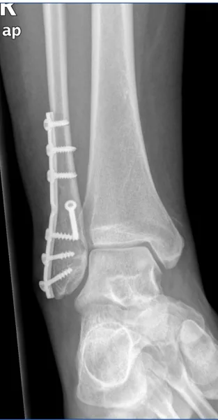 Placa de bloqueo de peroné distal – imagen 8