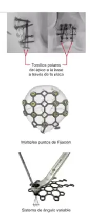 Placa bloqueada – malla de rótula – imagen 2